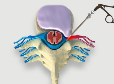 Minimally Invasive Spine Surgery